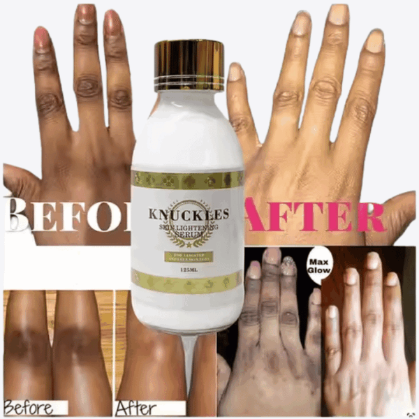 Extreme Lightening Serum – Dark Knuckles Remover, Deep Moisturizing, Hyperpigmentation Inhibition